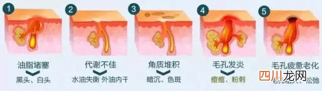 毛孔粗大怎么修复?