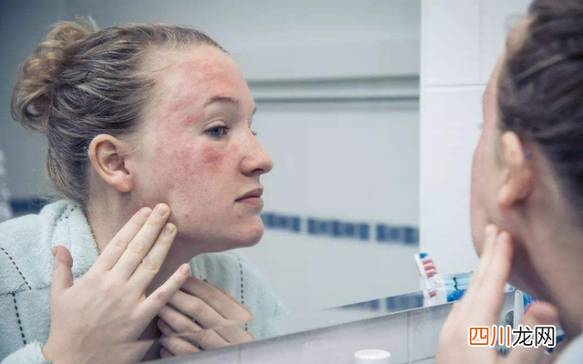 秋季荨麻疹高发季，这究竟是种什么病，该如何避免？