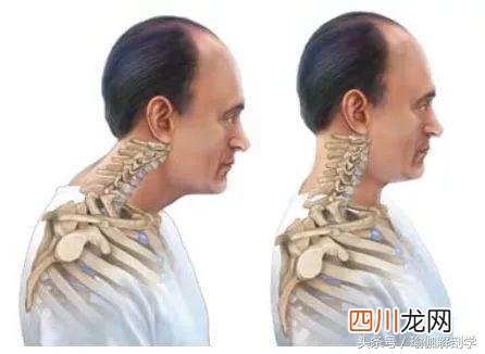 怎样消除颈部富贵包 如何消除颈部的“富贵包”？这些方法超级有效！