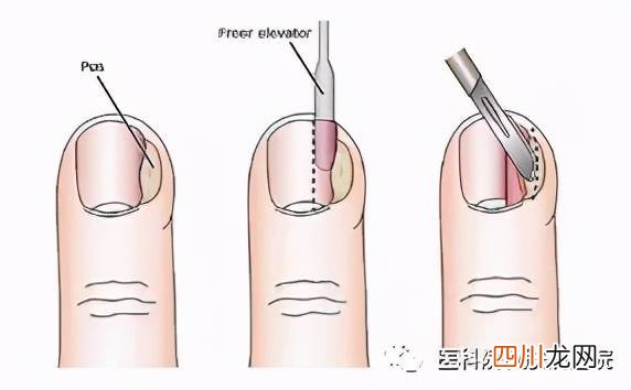 右脚大拇指指甲疼痛是什么原因 右脚大拇指疼预示什么