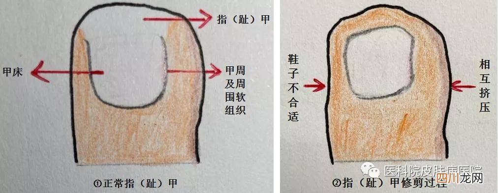 右脚大拇指指甲疼痛是什么原因 右脚大拇指疼预示什么