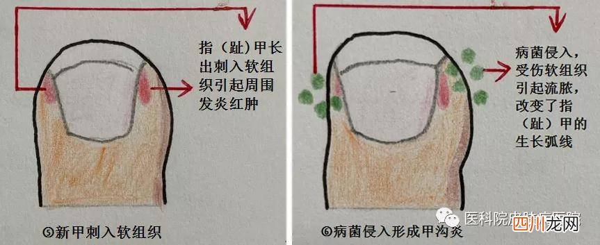 右脚大拇指指甲疼痛是什么原因 右脚大拇指疼预示什么