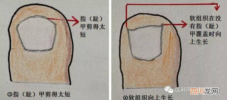 右脚大拇指指甲疼痛是什么原因 右脚大拇指疼预示什么