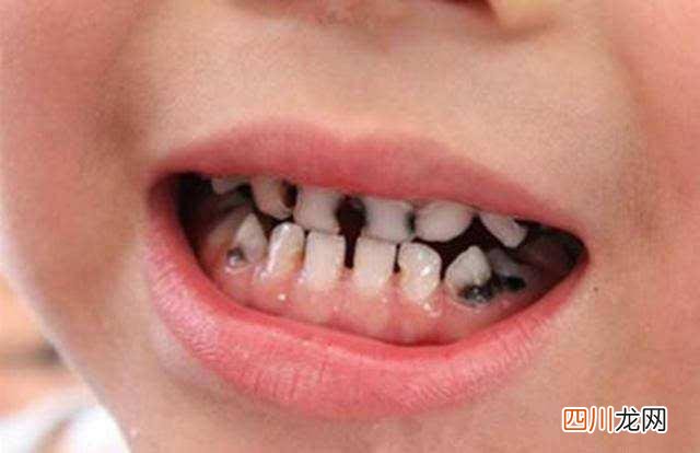 “十个孩子七个蛀”？天天刷牙还是防不住？多是以下几处没洗干净