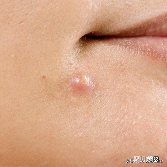 长痘后该如何处理？不是所有痘痘都能挤！学会2点轻松解决没痘印