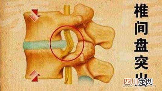 腰间盘突出50小偏方 腰间盘突出怎么治疗好的方法