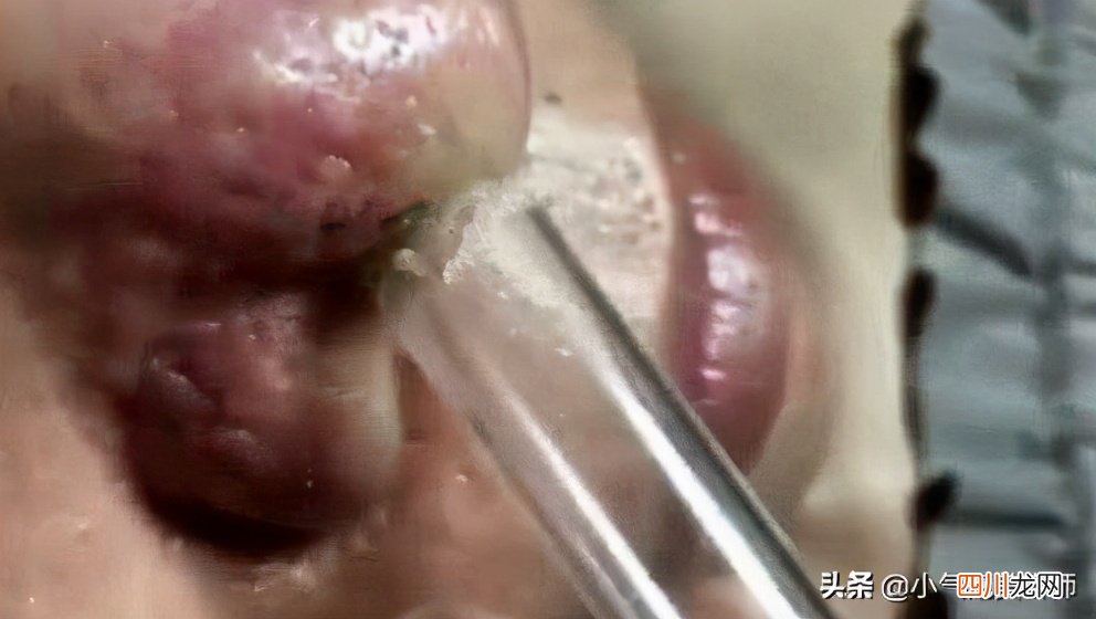 清理黑头最有效的方法 吸黑头粉刺仪器有用吗
