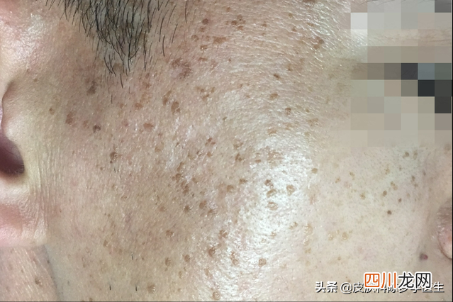 脖子上长了几十个 丝状疣是怎么引起的
