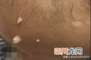 脖子上长了几十个 丝状疣是怎么引起的