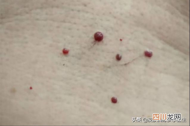 脖子上长了几十个 丝状疣是怎么引起的