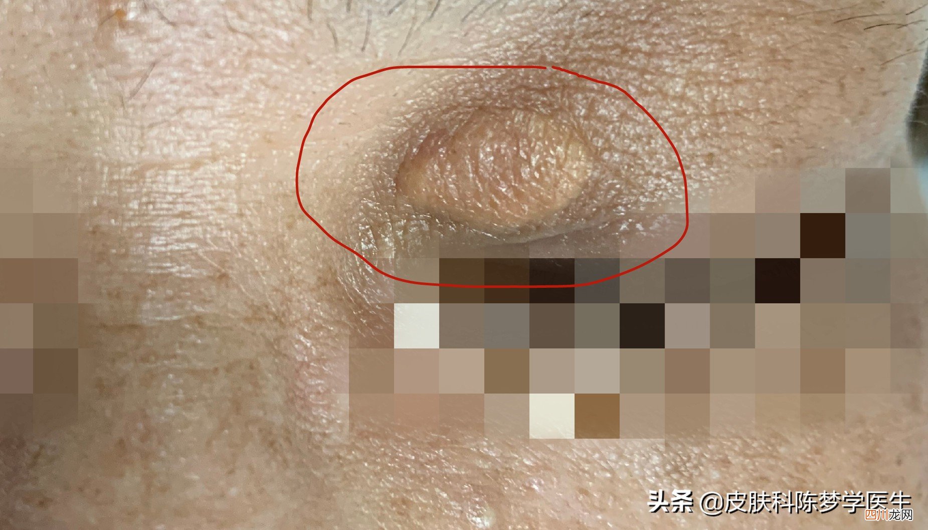 脖子上长了几十个 丝状疣是怎么引起的