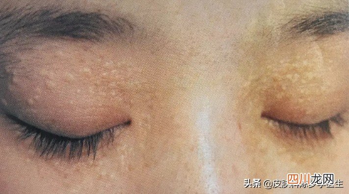 脖子上长了几十个 丝状疣是怎么引起的