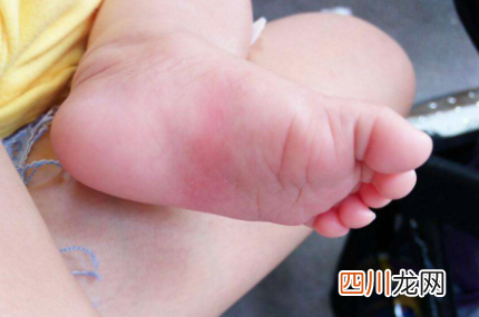 扁平足会不会遗传给孩子