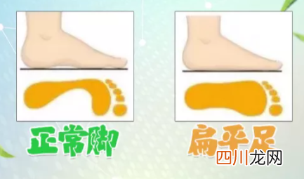 怎样辨别扁平足