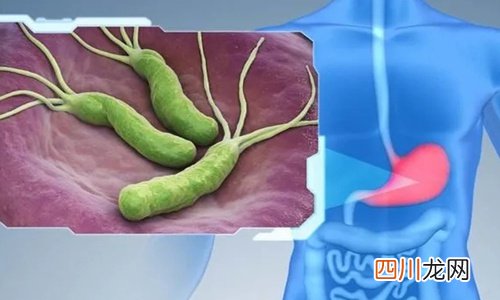 感染幽门螺杆菌会得胃癌吗？早早预防是关键！