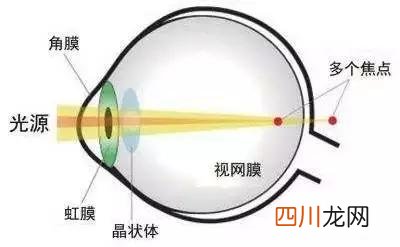 小孩散光能治好吗 什么是散光近视