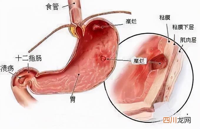 反流性胃炎反复发作怎么治疗 反流性胃炎怎么治疗