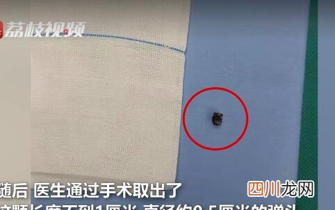 命真大！28岁小伙头部“挖”出埋20年弹头 被哥哥玩气枪打中头