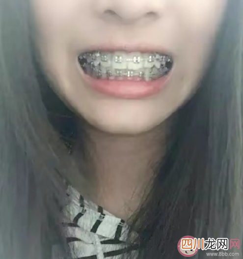 戴牙套真的可以变好看吗 隐形牙套和钢牙套到底哪个比较好