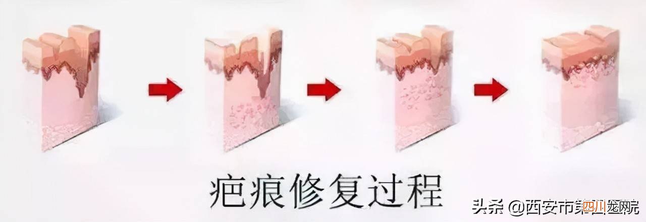 激光后多久掉痂 激光后多久结痂