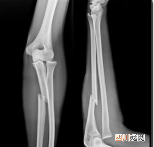 骨折手术后可以抽烟吗 手术后多久能抽烟