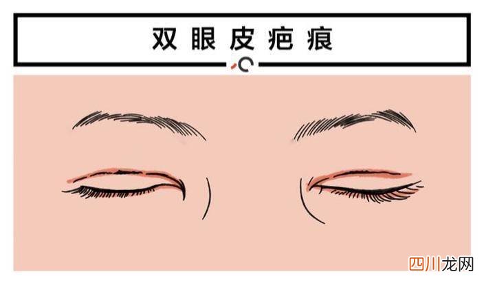 双眼皮多久能长好 双眼皮多久能化妆
