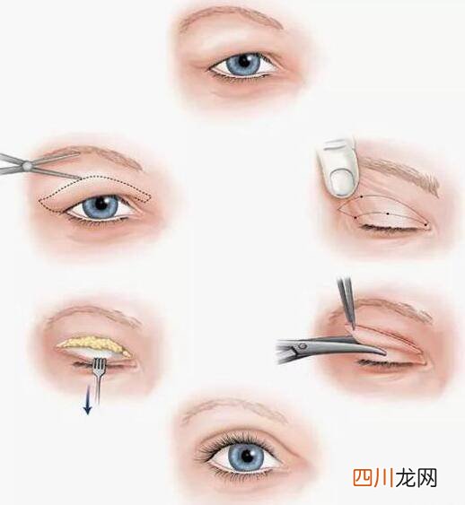 双眼皮多久能长好 双眼皮多久能化妆