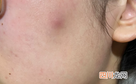 痘痘已经平了一直红着可以化妆吗