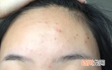 痤疮为什么不建议吃米诺环素