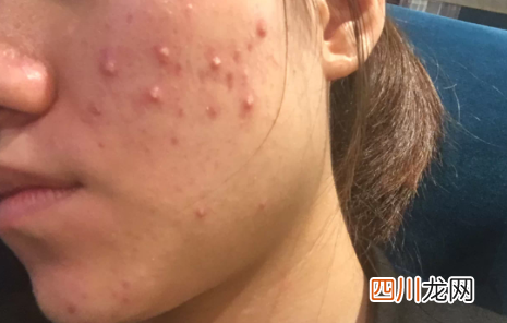 无脓头很大很硬的痘痘多久能消