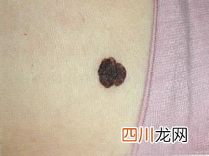 连日高温过度暴晒皮肤病发病率逐上升