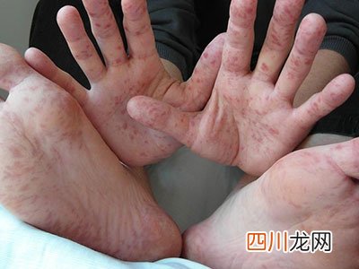 夏季要谨防手足口病和水痘流行