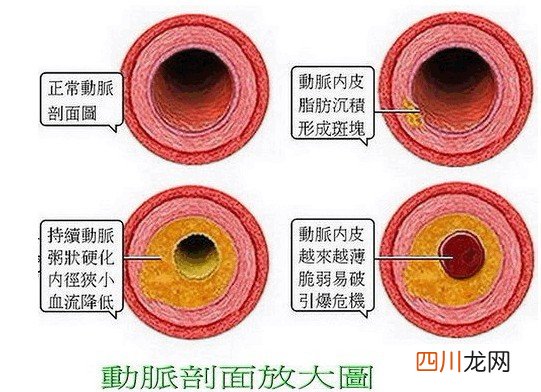 高血脂应该如何吃饭