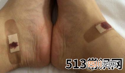 梦见脚出血有着怎样的特殊含义？