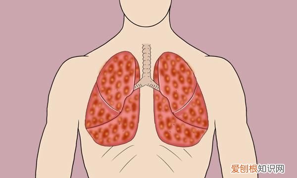 抽烟是导致肺癌的主要原因,肺癌大多数都是抽烟造成的吗