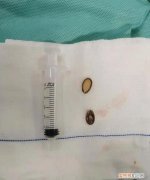 银川幼童不慎将瓜子吸入支气管，堵住右肺通道