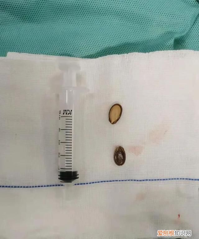 银川幼童不慎将瓜子吸入支气管，堵住右肺通道