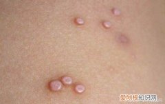 中医简单有效治疗瘊子的方法 瘊子怎么治