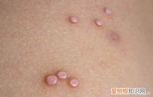 中医简单有效治疗瘊子的方法 瘊子怎么治