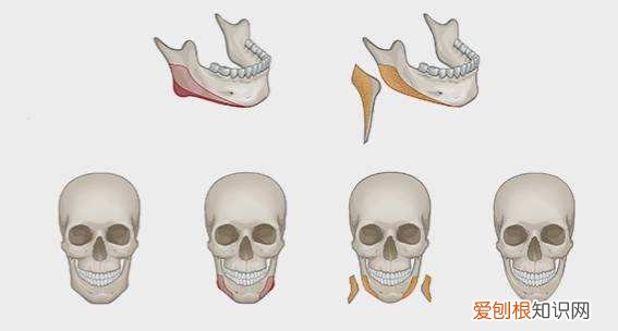 神秘的“磨骨”手术 削骨手术过程是怎样的