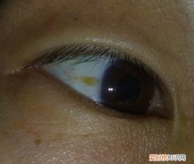 白眼球发黄有血丝是什么原因 白眼球发黄有血丝
