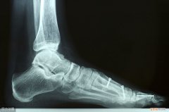 足跟骨刺的治疗方法 脚后跟骨刺的治疗方法