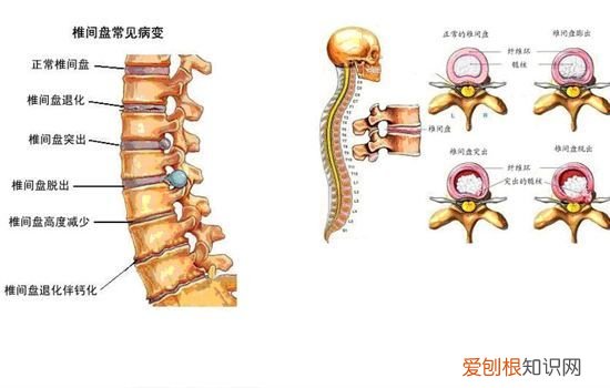 腰椎间盘突出症的治疗方法全集 治疗腰椎间盘突出的好方法