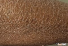 鱼鳞病是什么？ 什么是鱼鳞病