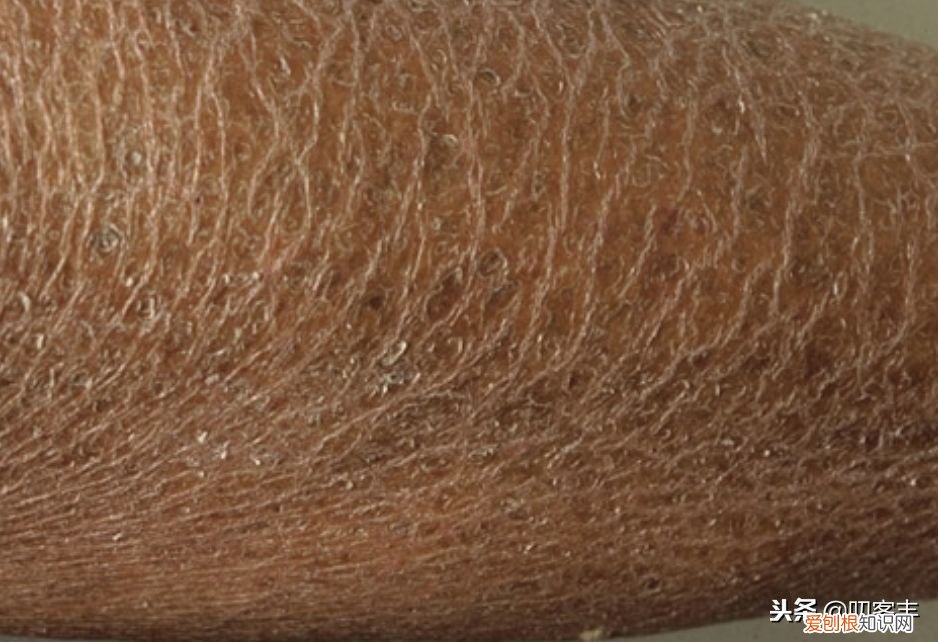 鱼鳞病是什么？ 什么是鱼鳞病