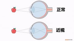 近视的危害您知道几个？ 近视的危害