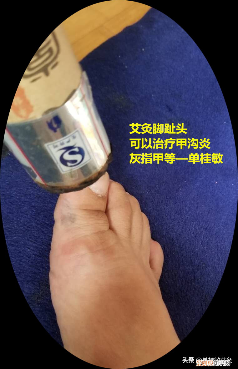 用艾灸治疗甲沟炎,灰指甲,方法简单 单桂敏艾灸博客