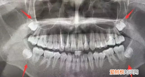 成年后都会长智齿吗 智齿什么时候长