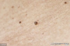 身上长了扁平疣怎么办 扁平疣的根治方法