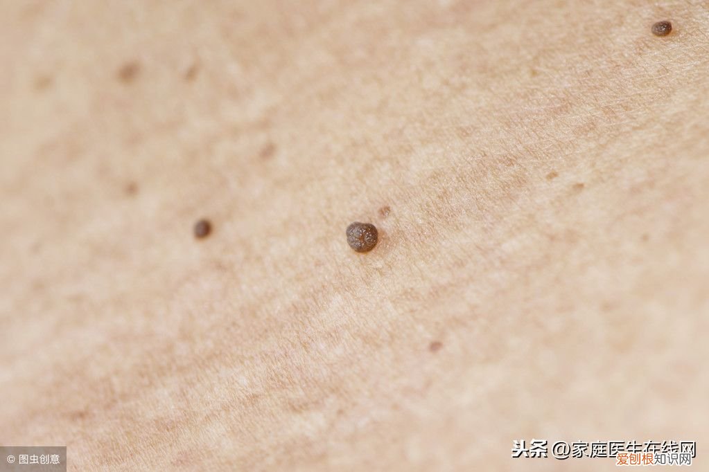 身上长了扁平疣怎么办 扁平疣的根治方法